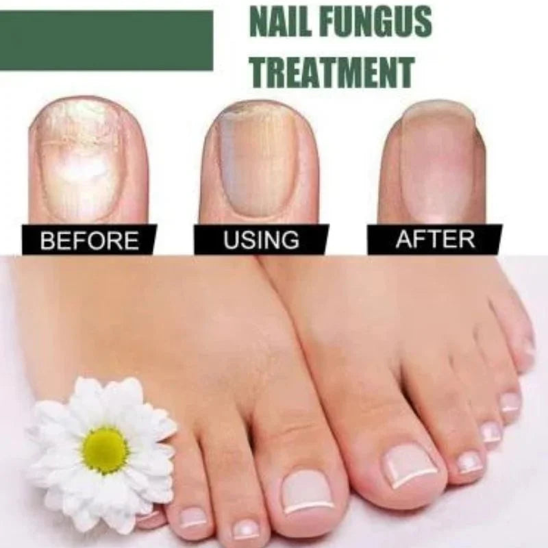 Fast Nail Fungu Fingernails & Toenails | Natural Nail Care Formula