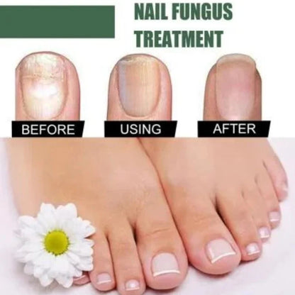 Fast Nail Fungu Fingernails & Toenails | Natural Nail Care Formula